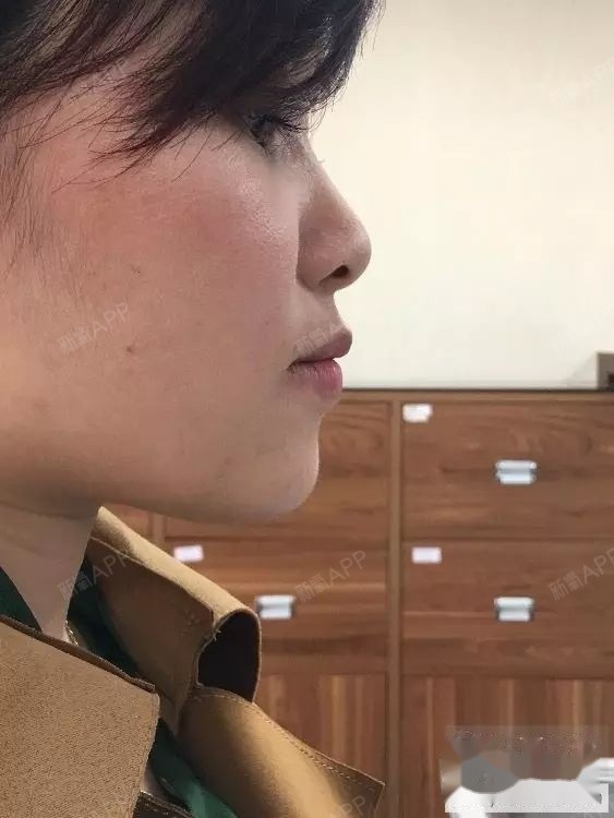 大龄骨性地包天矫正一年了。时间很快,虽然结