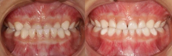 短下巴治疗前后对比 孩子牙齿没换完就不能做正畸?