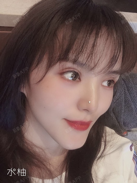 【青岛伊美尔5s重睑术 超微创开内眦】现在的眼睛,_圈子-新氧美容整形