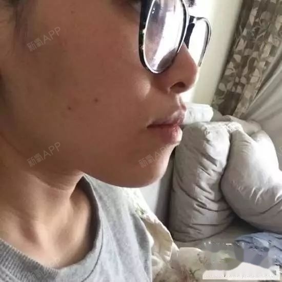 大龄骨性地包天矫正一年了。时间很快,虽然结