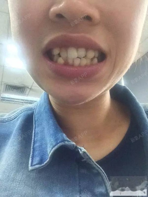 重叠的牙正在牙套中