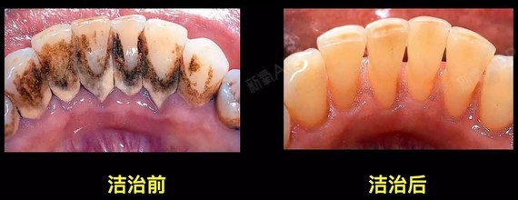 牙最大的作用是清理掉牙结石和牙菌斑