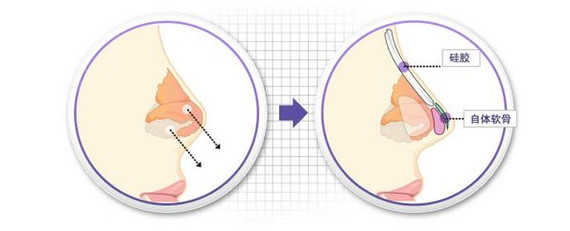哪种隆鼻手术好?爱美是女人的天性,没有那个女