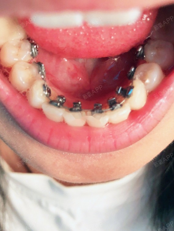 在纠结了很久之后还是选择去做活动翼舌内侧!