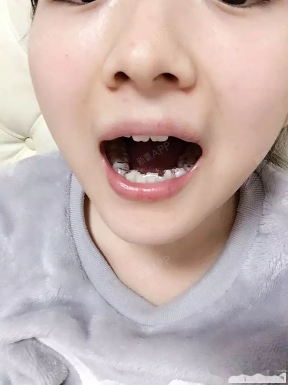 24周岁颞下颌关节综合症选择了正畸拔四颗牙矫正上4下4from