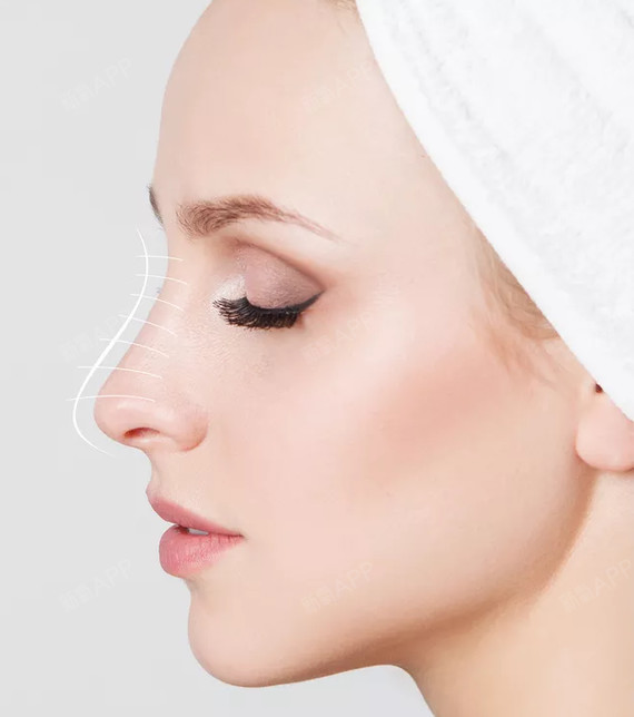 埋线提升面部多少钱?埋线提升面部多少钱?脸