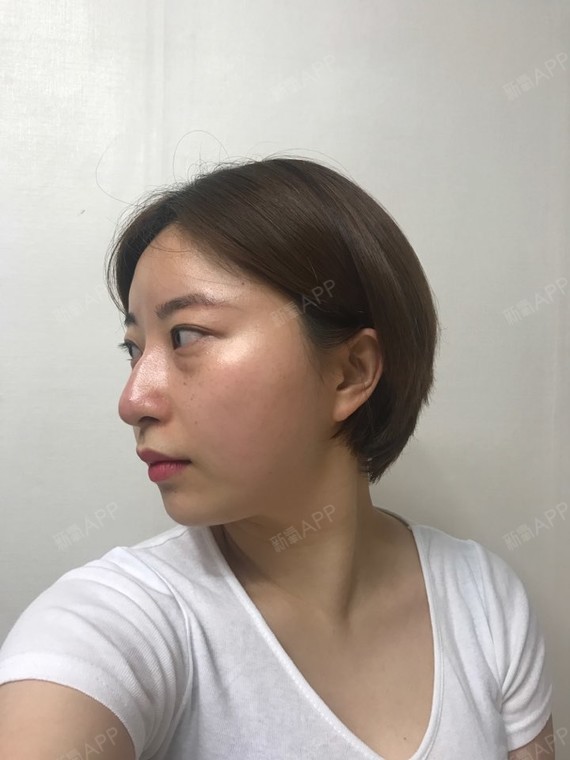 我呢,鼻子驼峰鼻严重,造成线整个条太过刚硬,没有美_圈子-新氧美容