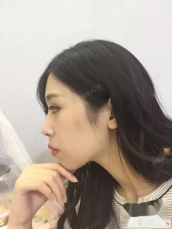牙套150天侧面对比 忽略妆看嘴巴,虽然没怎么收但好像下巴核桃