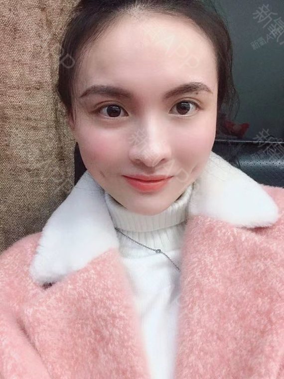 双侧埋线酒窝术后7天,两边消肿了很多,听医生说完全_圈子-新氧美容