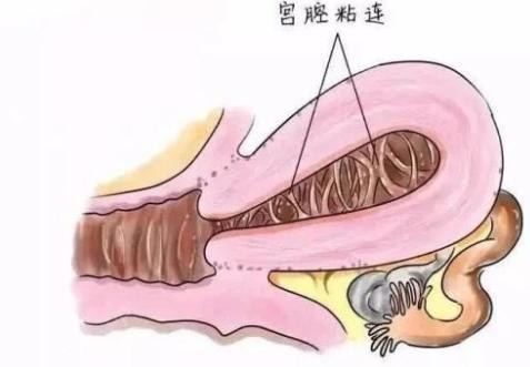 刮宫后注意事项,您遇到过刮宫术吗妇科刮宫后注意事项_圈子-新氧美容