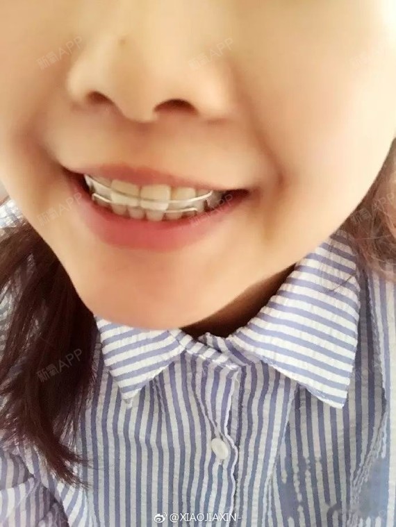 虎牙矫正741天拆啦保持器戴上说话会大舌头神啊我好想把我的钢牙召唤