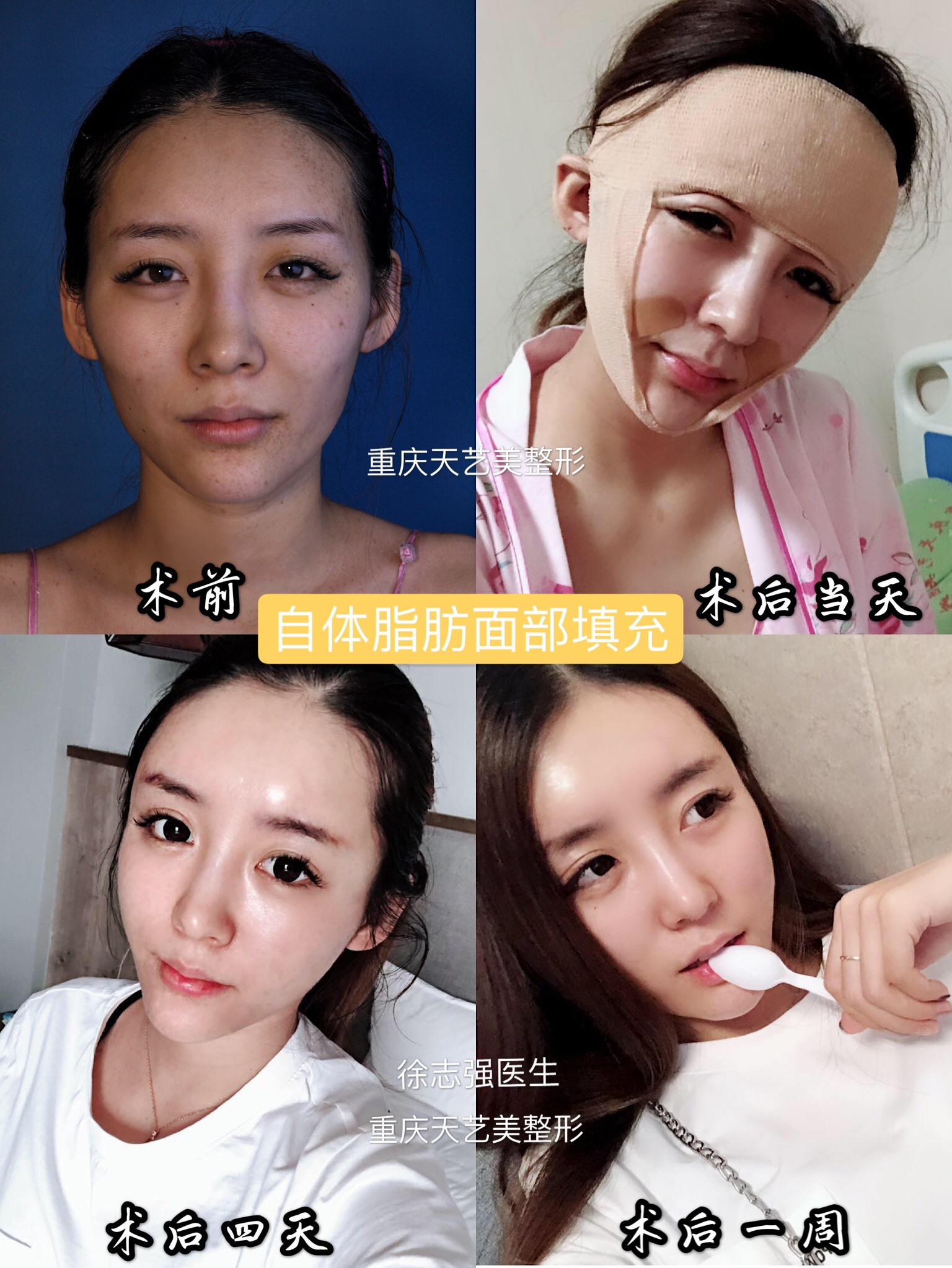 做了脂肪填充多久可以化妆 新氧美容整形