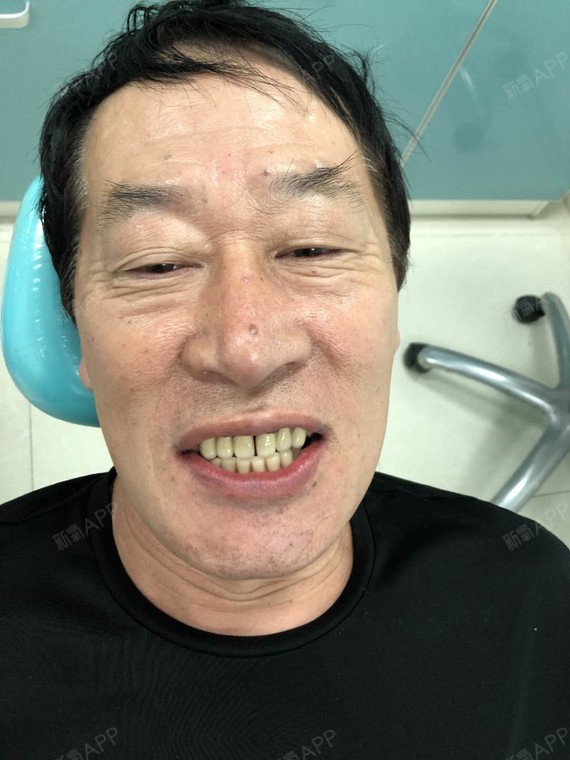 大连种植牙好不好_效果图_孙大爷种植牙术后第42天_新氧美容整形