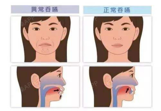 牙齿矫正后为什么还会复发?