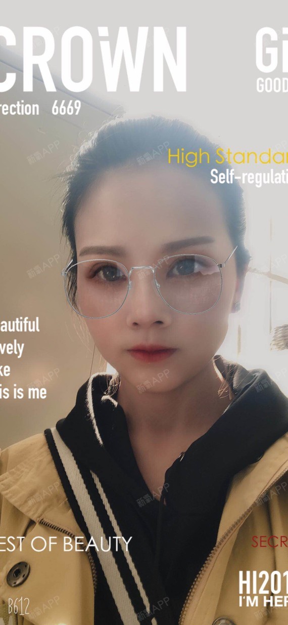 青岛伊美尔5s重睑术 超微创开内眼角术后30天,时_圈子-新氧美容整形