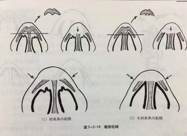 驼峰鼻示意图图片