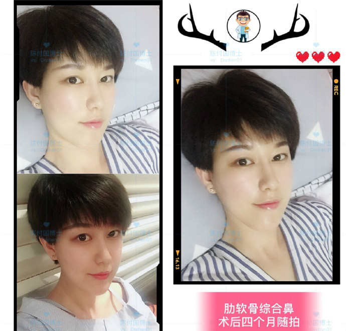 隆鼻后出现问题多久后可以修复 新氧美容整形