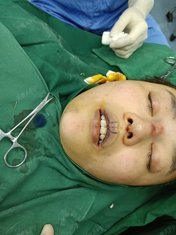 嘴巴手术图片图片