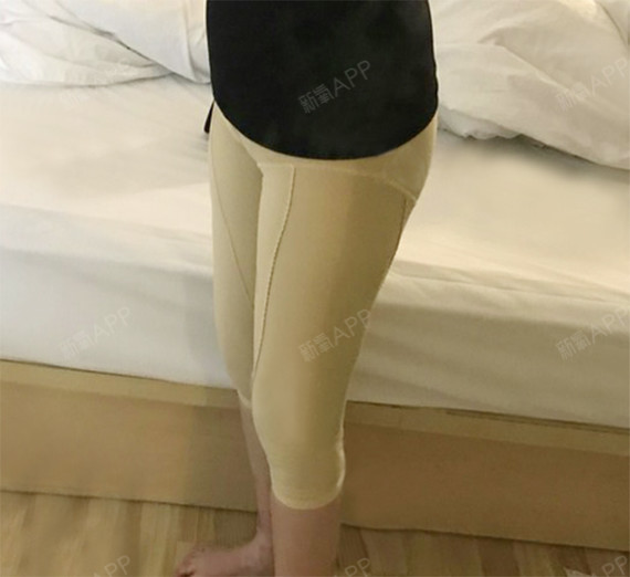 刚做完腿部吸脂第一天,肿胀期的比较严重,两腿也感觉_圈子-新氧美容