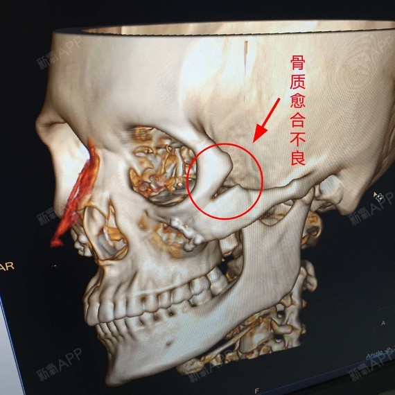 颧骨高千万不能马上做内推就怕几年后会后悔