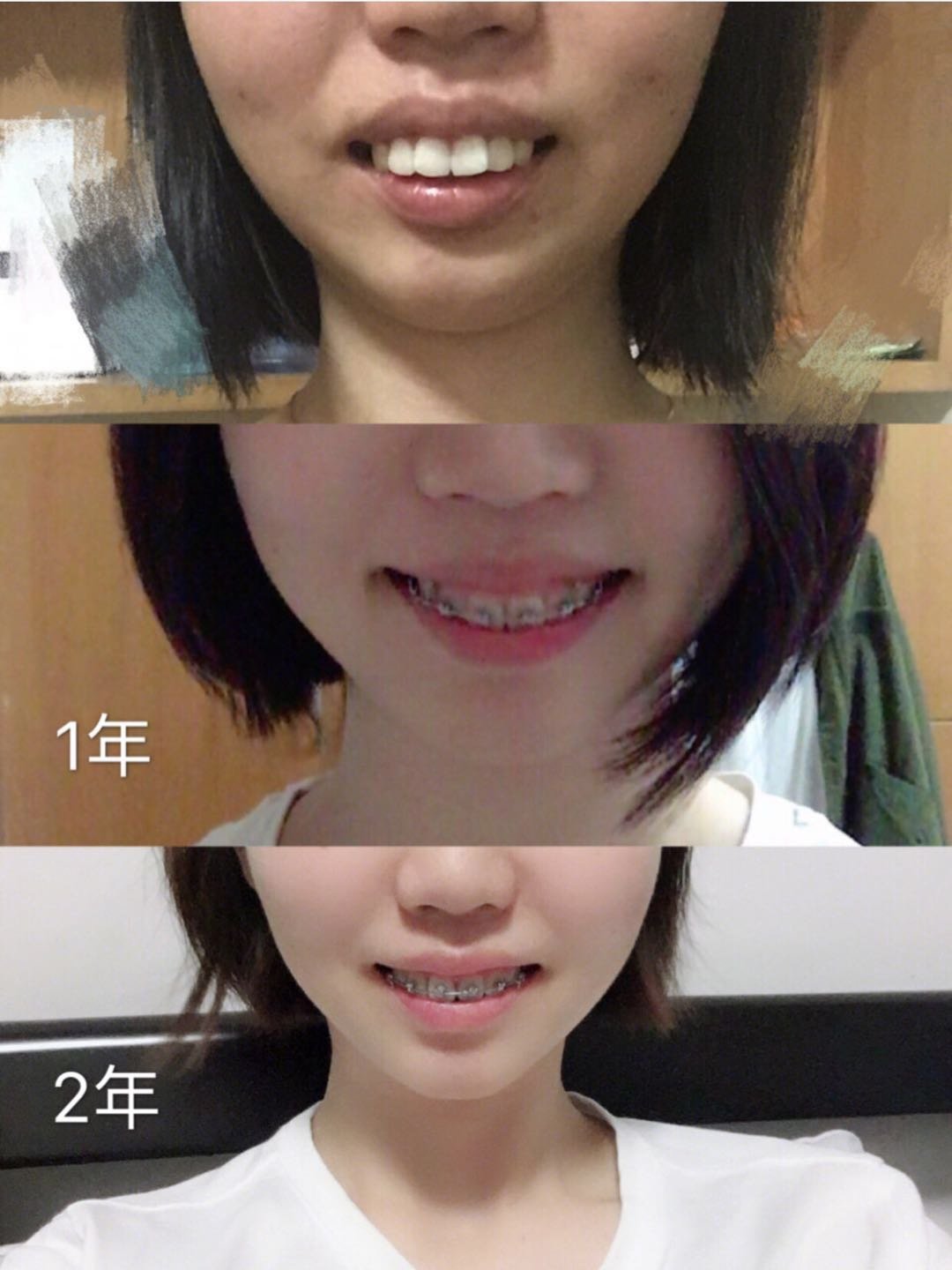牙齿矫正两年,骨性深覆合,阶段详细对比图
