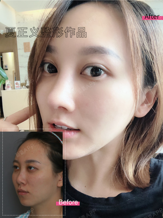 鼻子怎么变挺巫文云 怎么让鼻子变挺
