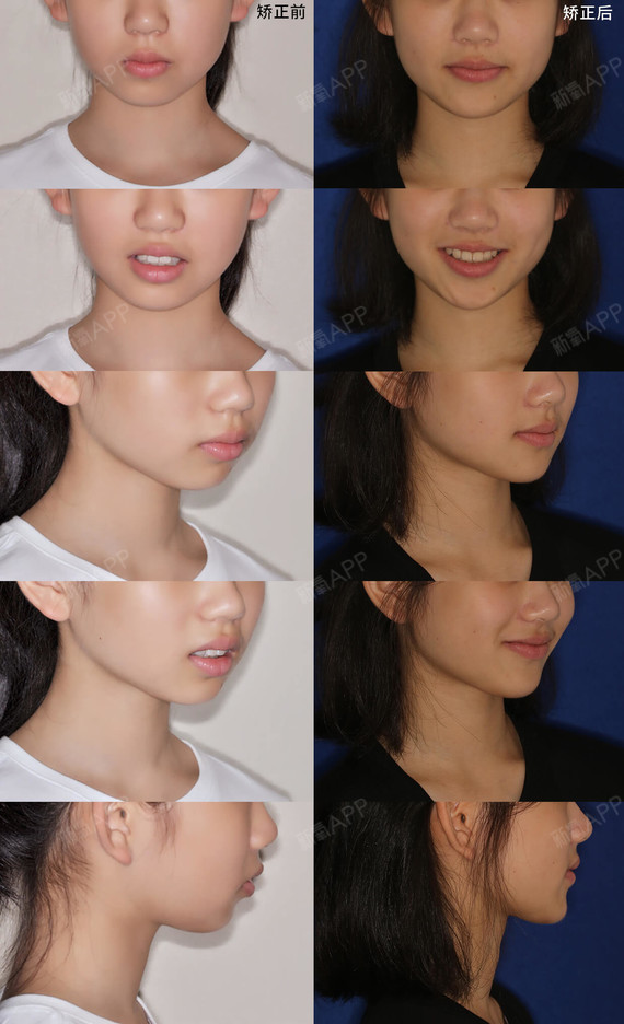 矫正前后面像对比这是一个眉眼十分清秀的小姑娘,脸型_圈子-新氧美容