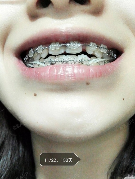 牙列稀疏和过小牙,不拔牙正畸