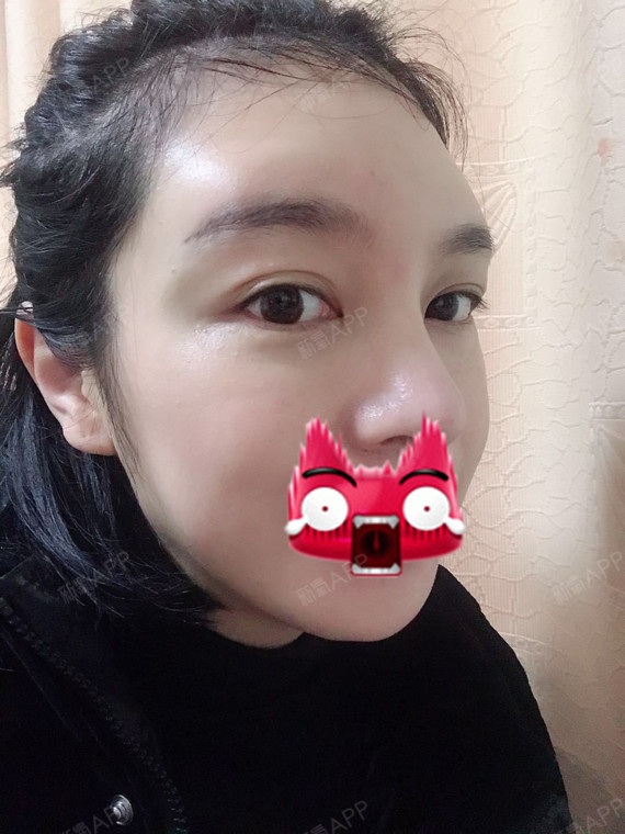 现在眉弓高了感觉整个五官都立体了,现在眉毛也好画了_圈子-新氧美容