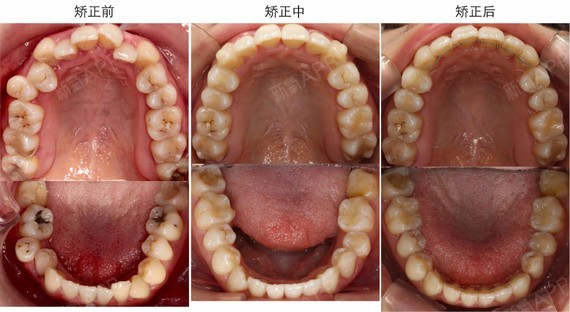 矫正前后面像对比女生牙齿拥挤严重,牙齿咬合非常乱,_圈子-新氧美容