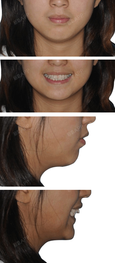 可以看出,这位女生属于错颌畸形,上下牙列拥挤,前牙深覆合,深覆盖