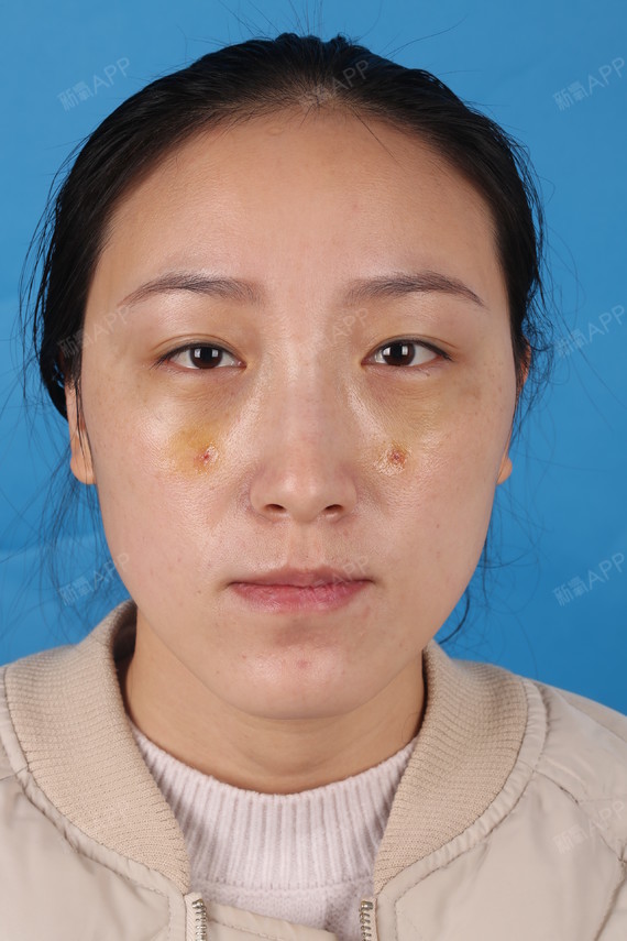 石家庄内切去眼袋好不好_效果图_氧气z8j2l内切去眼袋术后第5天_新氧