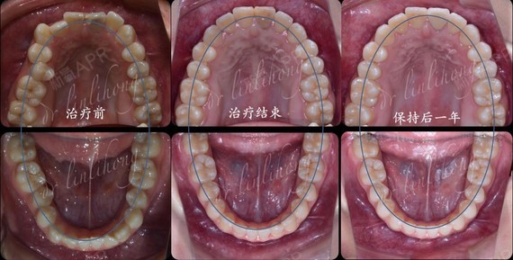 治疗前这个20岁的女生因为