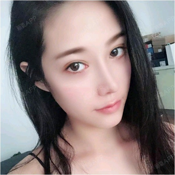 自体耳软骨隆鼻必看科普为什么选择三个月前;