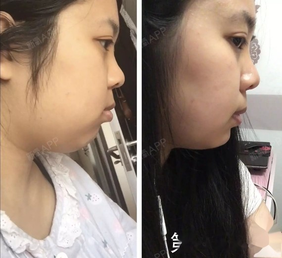 戴牙套前和第51天对比 戴牙套前和第51天对比