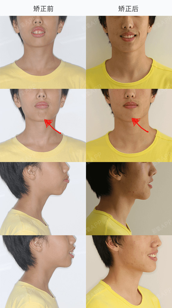 抿紧双唇时,颏部肌肉紧张(箭头标示的位置),嘴唇也有外翻的感觉.