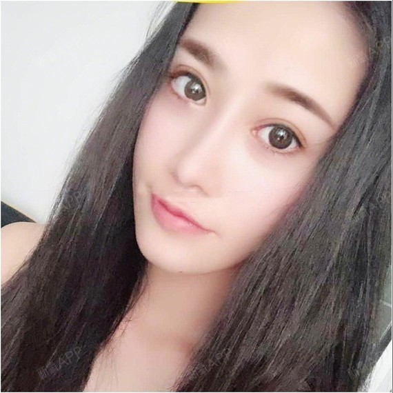 自体耳软骨隆鼻必看科普为什么选择三个月前;