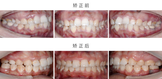 矫正前后面像对比这个女孩觉得牙齿拥挤前突,嘴巴前突,没有下巴,另外