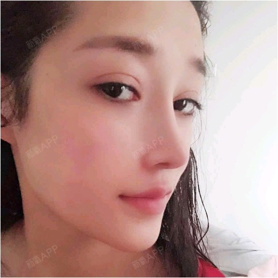 自体耳软骨隆鼻必看科普为什么选择三个月前;