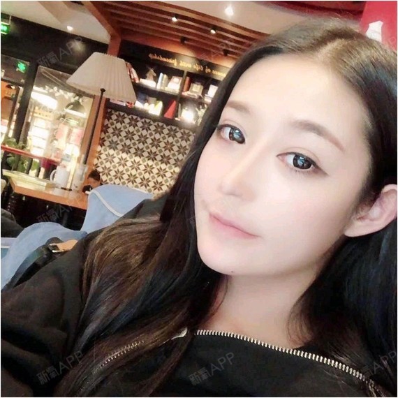 自体耳软骨隆鼻必看科普为什么选择三个月前;