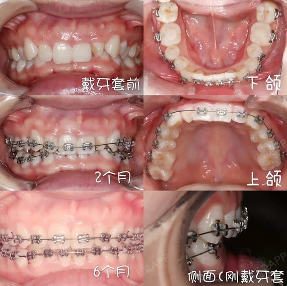写在前面 牙齿矫正绝对是影响人生的大事 它也绝对不 圈子 新氧美容整形