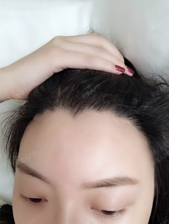 我是天生大脑门,老妈说聪明,可是不敢明目张胆的见人_圈子-新氧美容