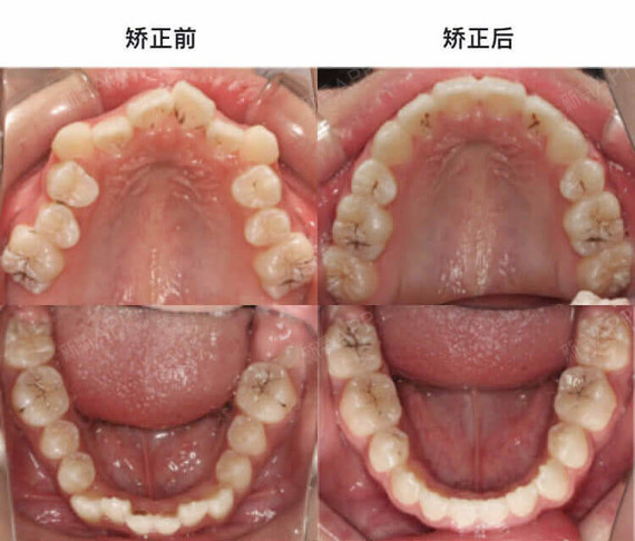 治疗后咬合关系得到改善,牙齿排齐,前突的牙齿也内收进去了