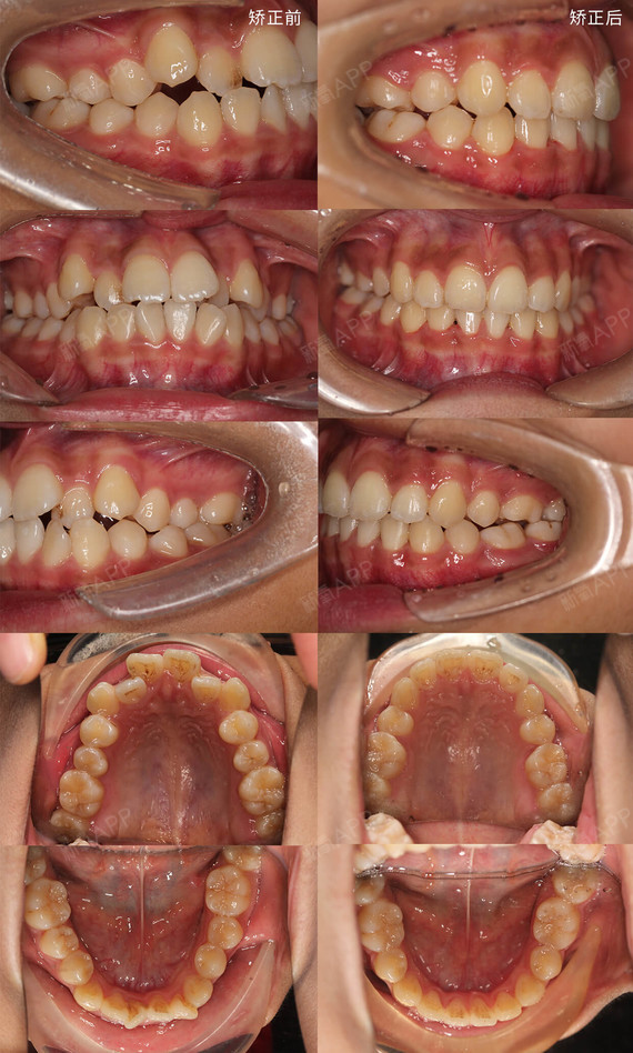 牙齿矫正牙列拥挤图片图片