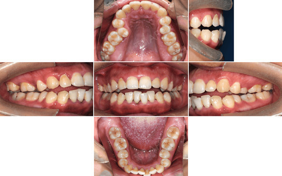 骨性下颌骨后缩,也就是没有下巴,不仅会影响一个人的_圈子-新氧美容