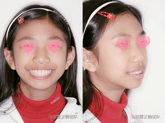 除了影响健康,更会打击孩子的自信心,削减孩子的快乐,12岁牙齿矫正