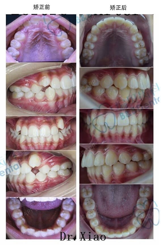 牙齿矫正