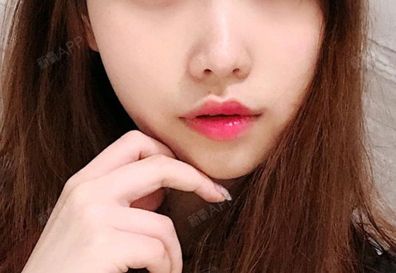 下巴真的看着越来越自然了,弧度过度的很自然流畅,还_圈子-新氧美容