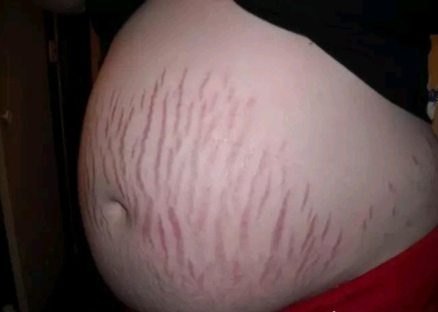 生完孩子后肚子上有很多妊娠纹 听说可 新氧美容整形