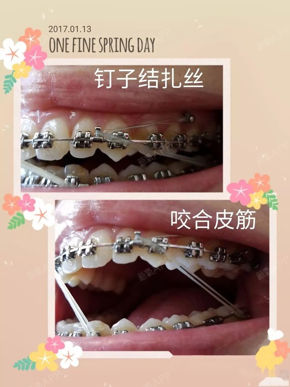 拉丁训练 牙套一年整~ 2017.1.